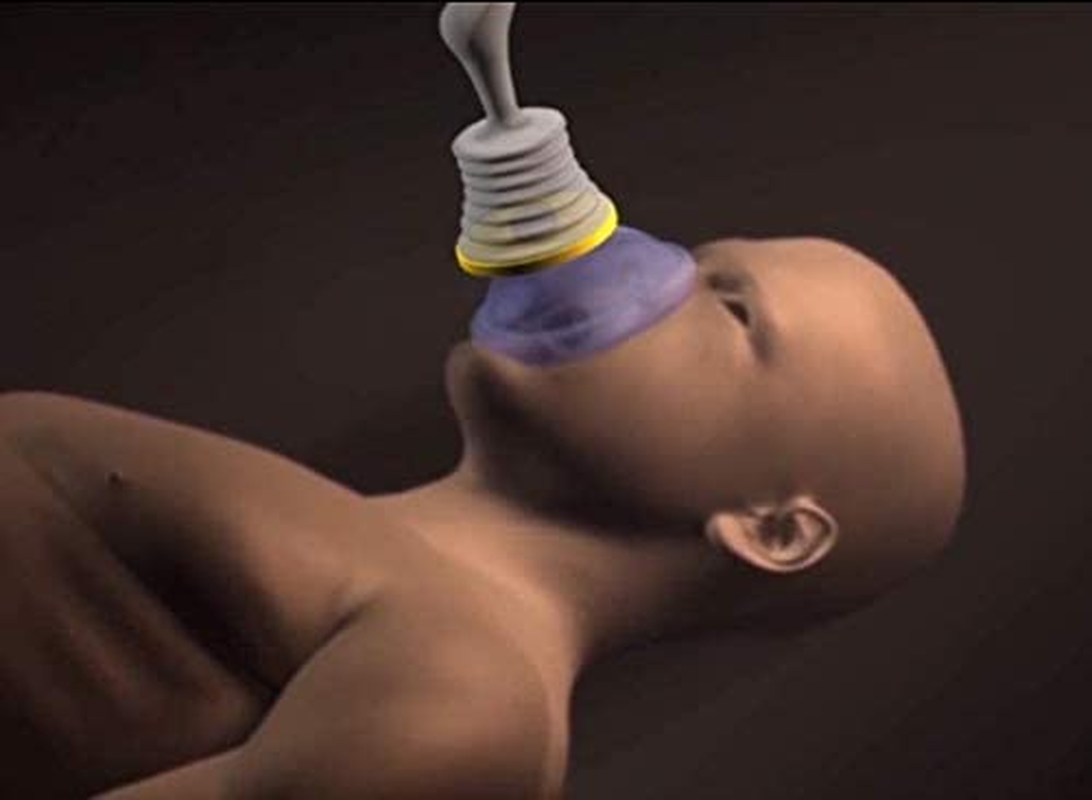 Portable Choking Rescue Device