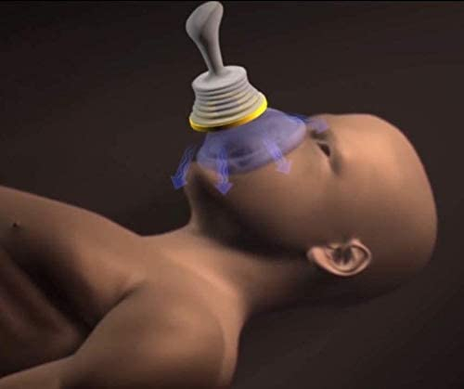 Portable Choking Rescue Device