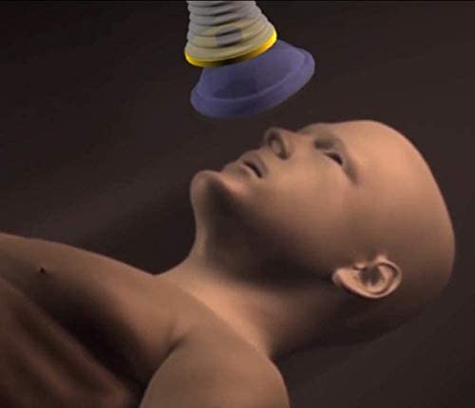Portable Choking Rescue Device